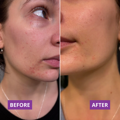 Before and after — Sarah,32